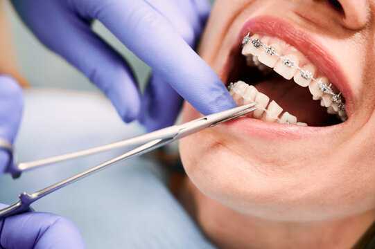 braces-treatment-cost-in-pune-starts-at-rs29999-emi-available-big-0