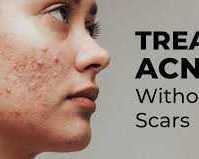 why-should-you-choose-professional-care-for-acne-prone-skin