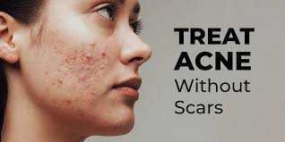 why-should-you-choose-professional-care-for-acne-prone-skin-big-0