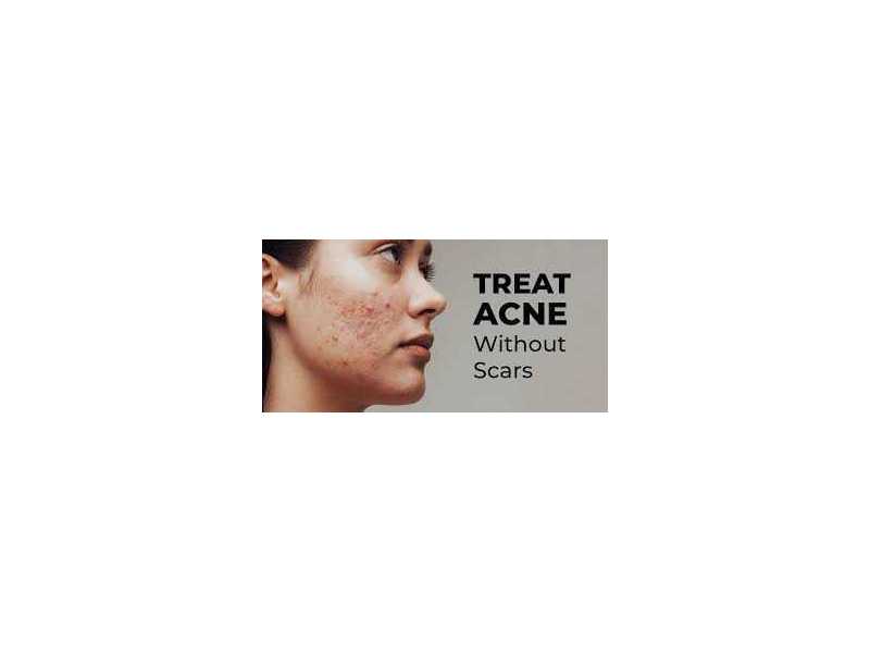 why-should-you-choose-professional-care-for-acne-prone-skin-small-0