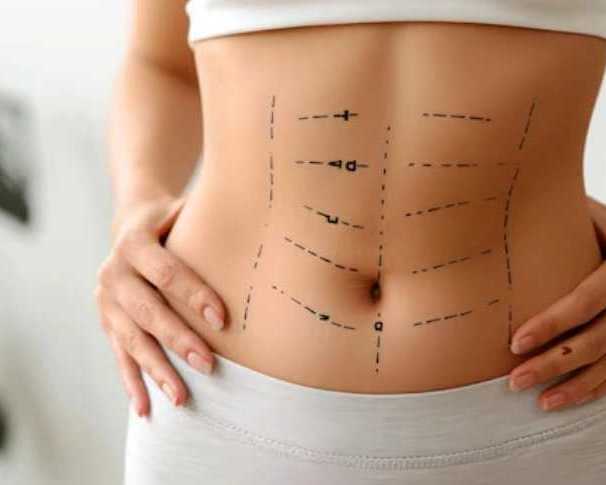 best-abdominoplasty-in-gurgaon-by-dr-shilpi-bhadani