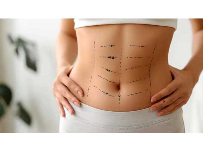 best-abdominoplasty-in-gurgaon-by-dr-shilpi-bhadani-small-0