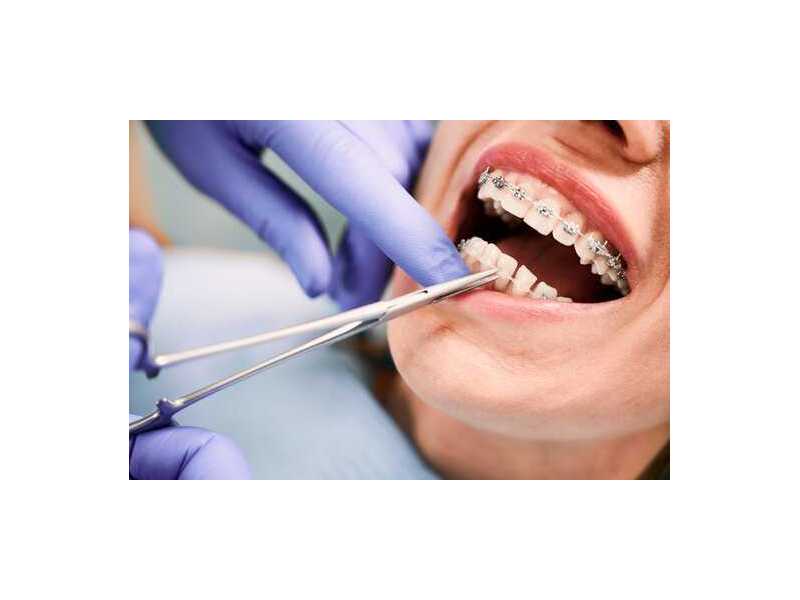 braces-treatment-cost-in-pune-get-teeth-braces-starting-at-rs29999-small-0