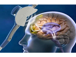 Transcranial Magnetic Stimulator Market 2023 Major Key Players and Industry Analysis