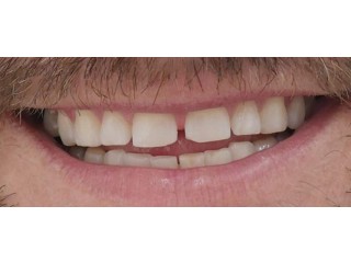 Get the Best Tooth Gap Treatment in Delhi