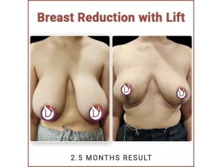Breast Reduction Surgery in India | World's Best Plastic Surgeon Dr. Amit Gupta