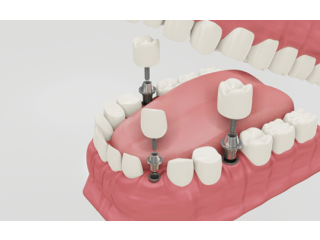 Dental implants in Ahmedabad | Aashu dental | 9825158578
