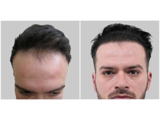 Trusted Clinic for Hair Transplant in Gurgaon - Satya Hair Solutions
