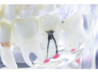 Root Canal Treatment Cost In Mumbai | Expert Dental Care