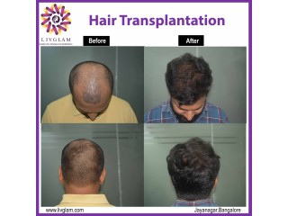 Best Hair Transplantation in Bangalore | Hair Grafting Cost in Bangalore