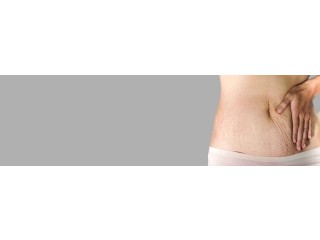 Stretch marks treatment in Hyderabad
