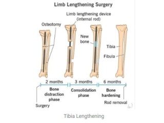 Limb Lengthening Surgery