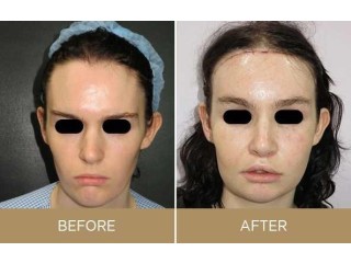 Facial Feminization Surgery Cost in USA