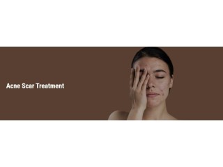 Acne scar treatment in south Delhi- skination clinic
