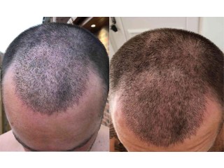 Hair Transplant Aftermath: The 15-Day Milestone Explained