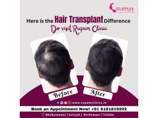 Rupam Clinic: Best Hair Transplant Clinic in Bhubaneswar
