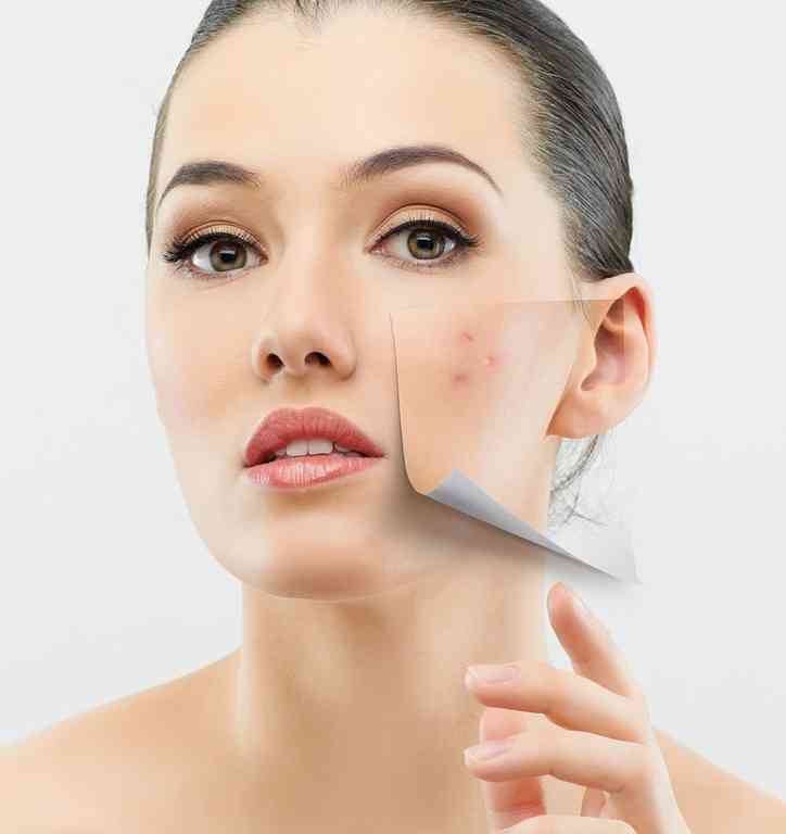 transform-your-skin-laser-treatment-for-acne-scars-big-0