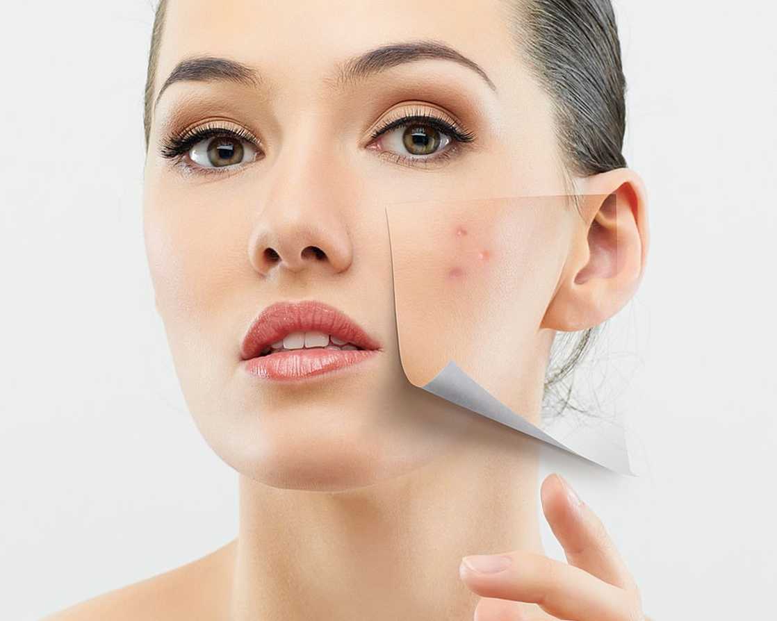 transform-your-skin-laser-treatment-for-acne-scars