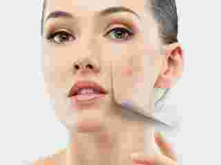 transform-your-skin-laser-treatment-for-acne-scars-small-0