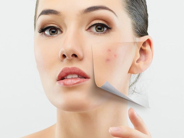 transform-your-skin-laser-treatment-for-acne-scars