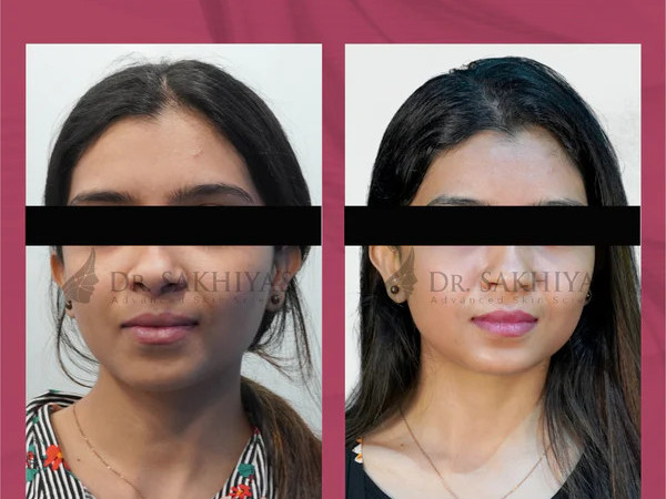 glowmelan-the-best-skin-lightening-cream-for-sensitive-skin-big-1