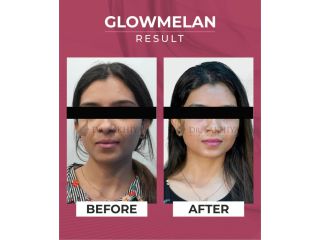 glowmelan-the-best-skin-lightening-cream-for-sensitive-skin-small-1