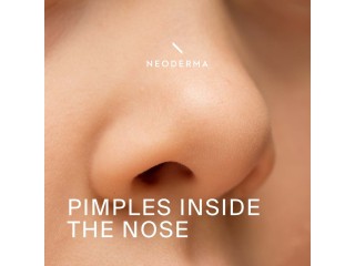 Pimple Inside Nose | NEODERMA
