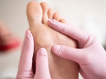 foot-corn-removal-singapore-gentle-professional-foot-care