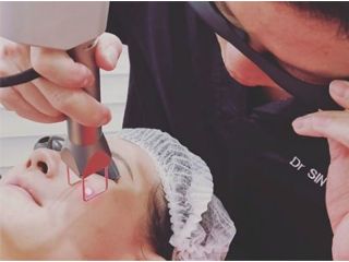 non-surgical-facelift-acne-scar-treatment-singapore-small-0