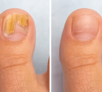 fungus-nail-specialist-singapore-effective-infection-treatment-big-0