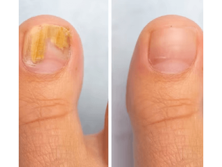 fungus-nail-specialist-singapore-effective-infection-treatment-small-0