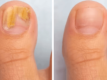 fungus-nail-specialist-singapore-effective-infection-treatment