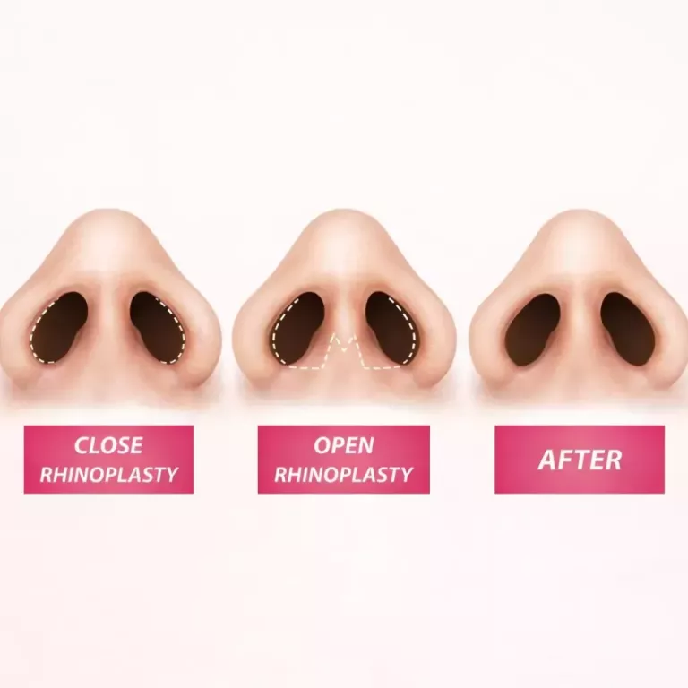 nasal-plastic-surgery-in-singapore-by-specialist-big-0