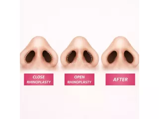 nasal-plastic-surgery-in-singapore-by-specialist-small-0