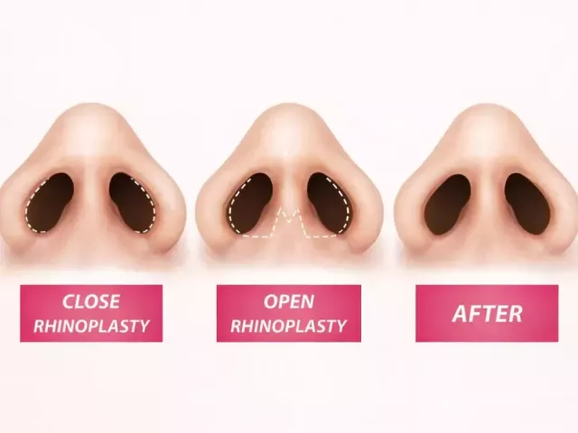 nasal-plastic-surgery-in-singapore-by-specialist