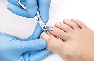 expert-foot-corn-removal-singapore-safe-clinical-care-big-0