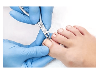 expert-foot-corn-removal-singapore-safe-clinical-care-small-0