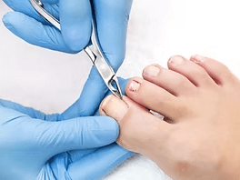 expert-foot-corn-removal-singapore-safe-clinical-care