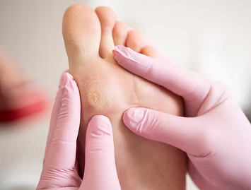 effective-foot-corn-removal-singapore-by-trusted-podiatry-experts-big-0