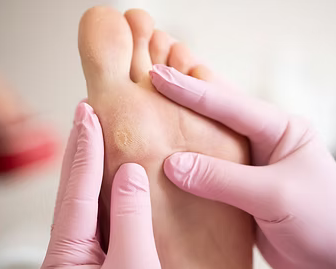effective-foot-corn-removal-singapore-by-trusted-podiatry-experts
