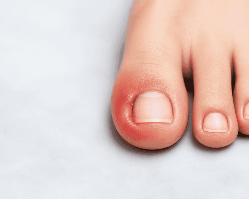 nail-fungus-treatment-singapore-expert-care-for-healthy-nails