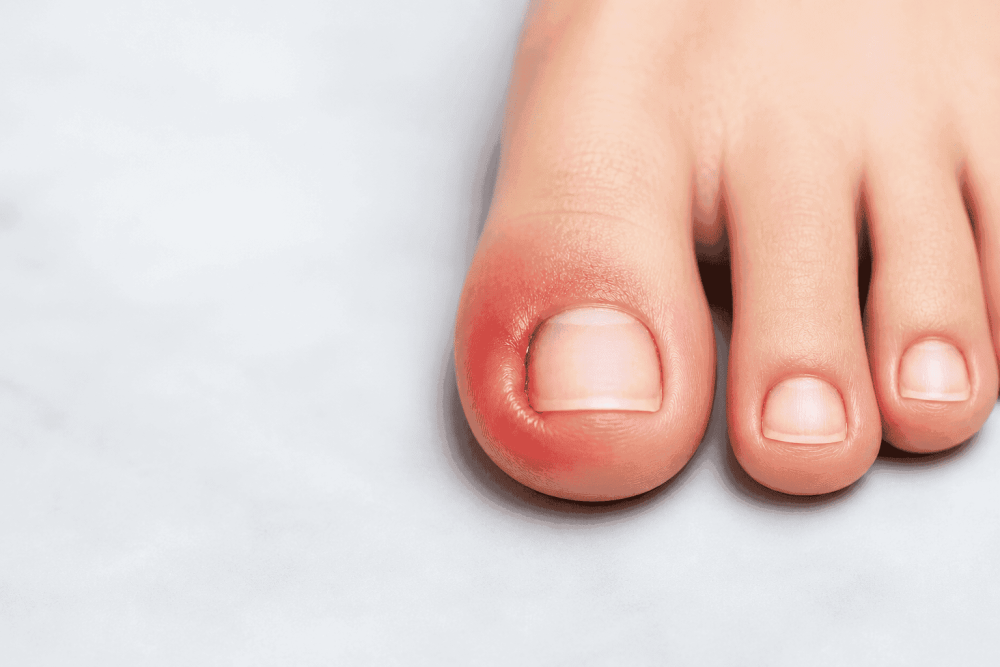 nail-fungus-treatment-singapore-expert-care-for-healthy-nails-big-0