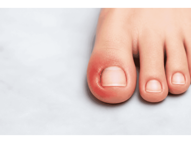 nail-fungus-treatment-singapore-expert-care-for-healthy-nails-small-0