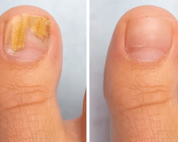 trusted-fungus-nail-specialist-singapore-for-healthy-nails