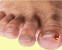 painful-ingrown-toenail-get-expert-care-today