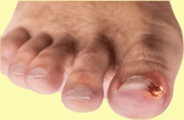 painful-ingrown-toenail-get-expert-care-today-big-0
