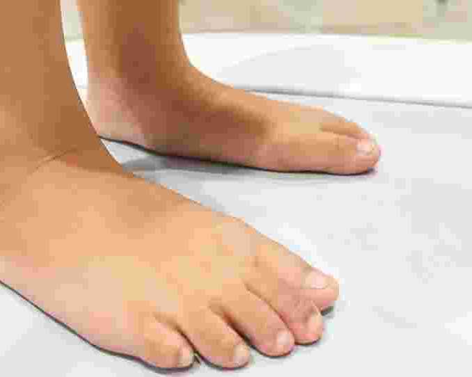 flat-foot-treatment-singapore-by-certified-podiatrists