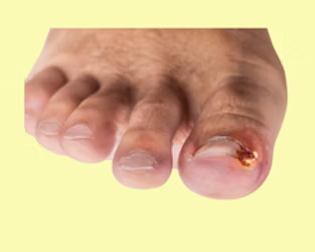 podiatrist-and-ingrown-toenail-treatment-fast-relief-from-foot-pain