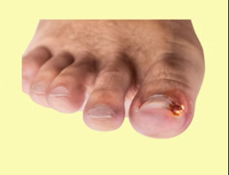 podiatrist-and-ingrown-toenail-treatment-fast-relief-from-foot-pain-big-0