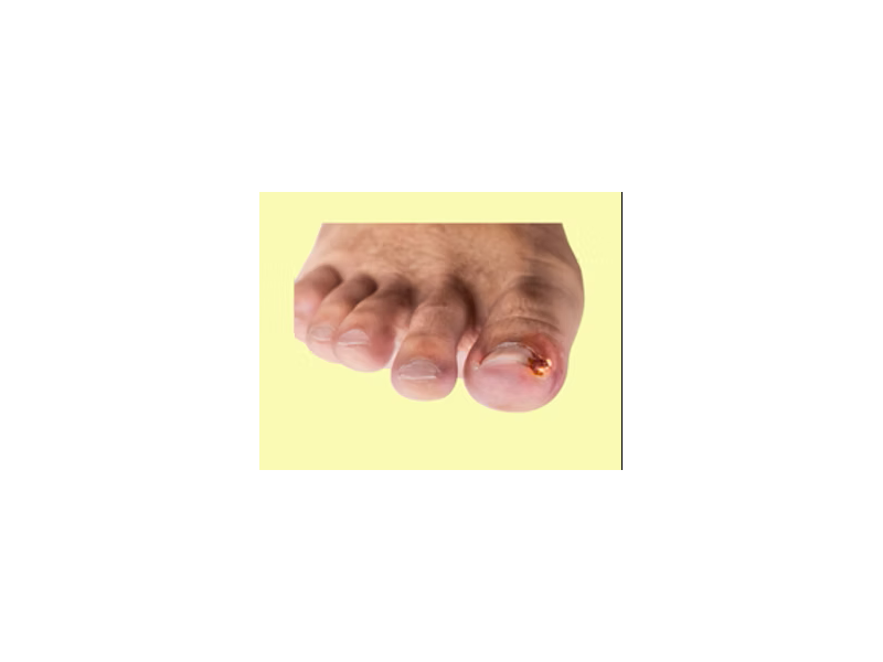 podiatrist-and-ingrown-toenail-treatment-fast-relief-from-foot-pain-small-0